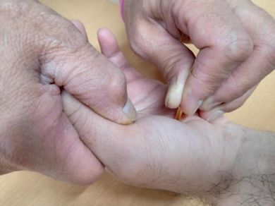 第1手根中手関節機能障害の治療